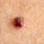 Fibroma trattamento plasmage