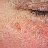 Lentigo macchie solari trattamento plasmage